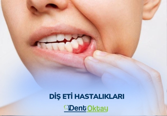 Periodontoloji (Diş Eti Hastalıkları)